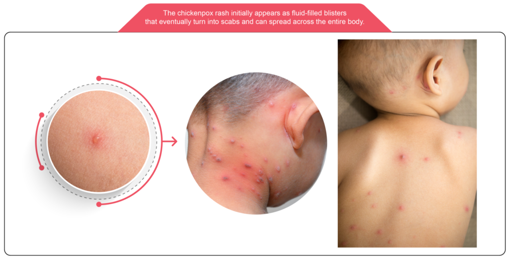 Chickenpox And Varicella Vaccination Frontier Healthcare Group Chickenpox And Varicella Vaccination Frontier Healthcare Group